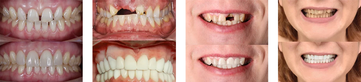Teeth Gallery single 7 Teeth Gallery single
